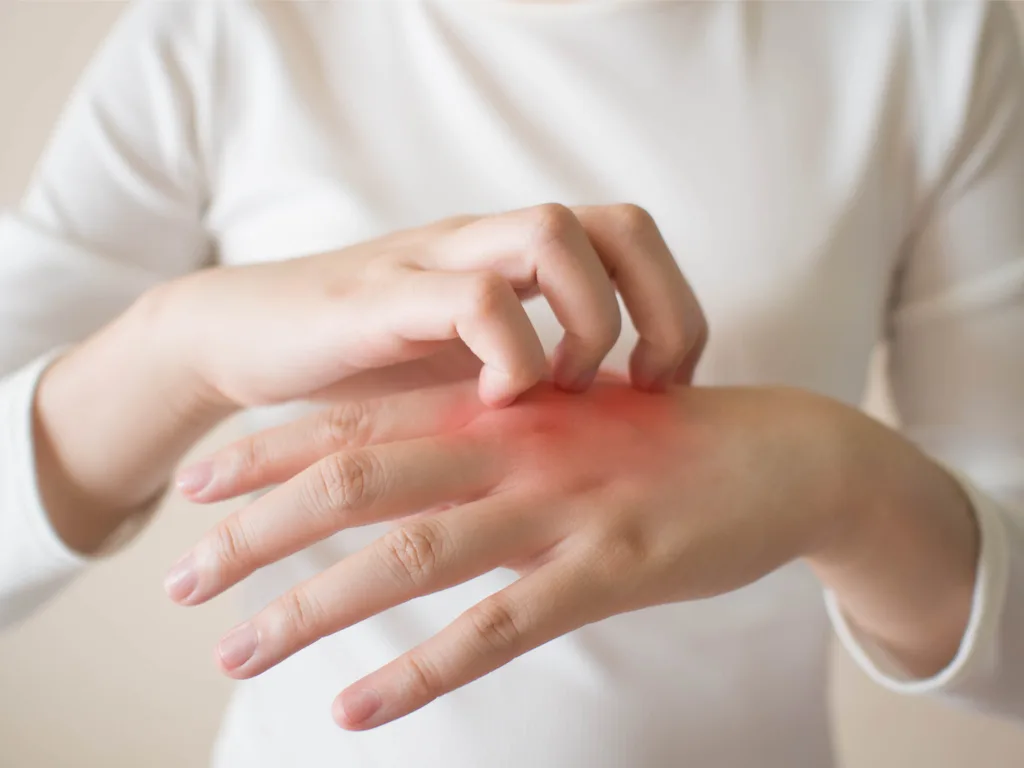 What You Need to Know About Eczema