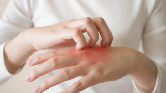 What is the Difference Between Dermatitis and Eczema?