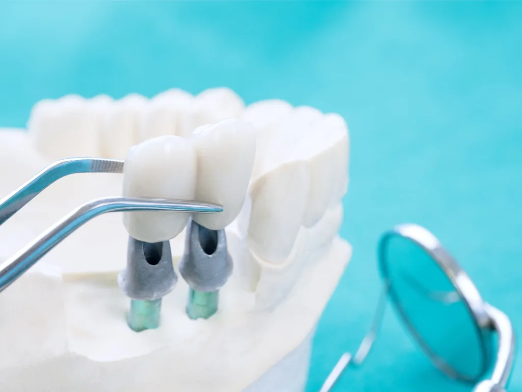 Should You Get a Dental Implant?